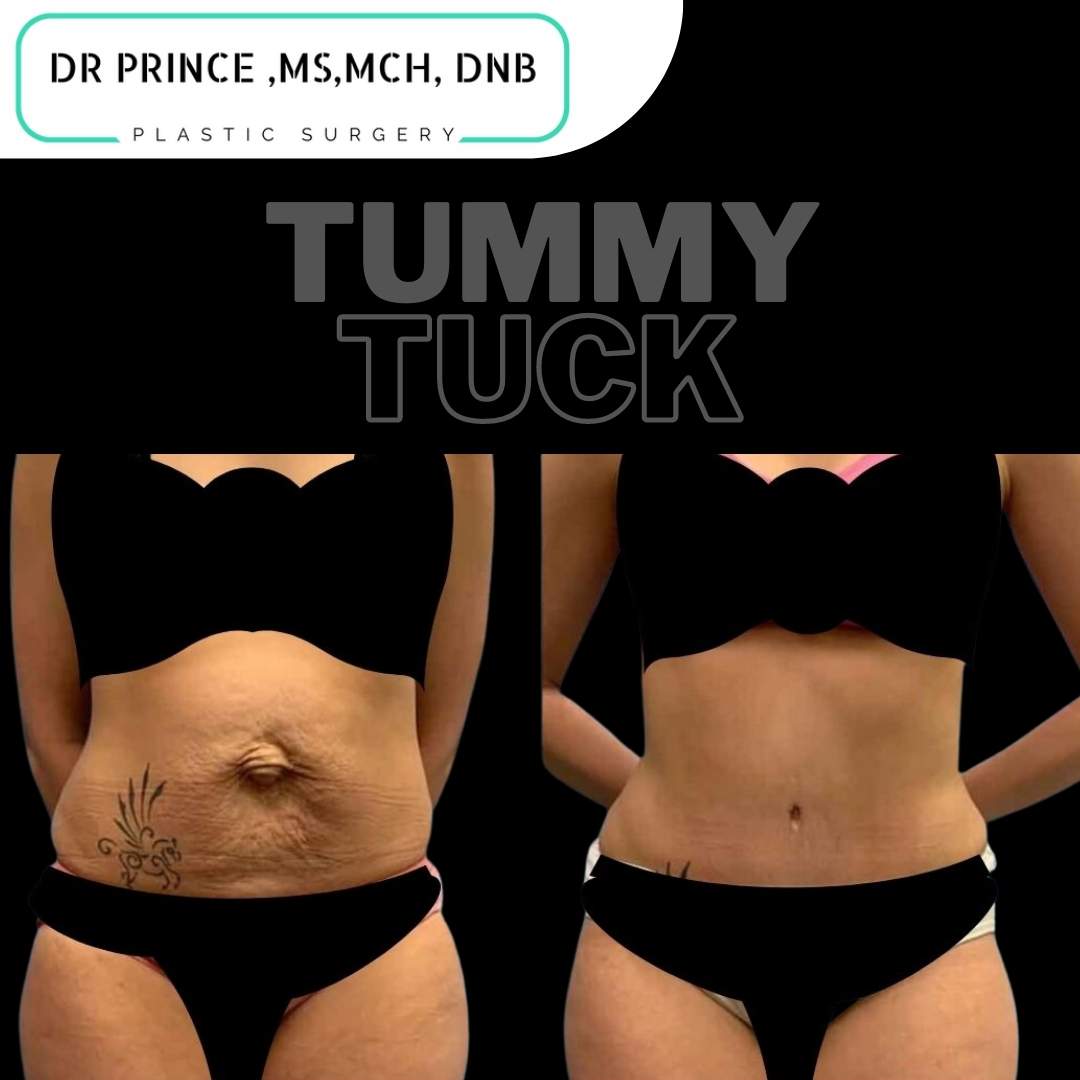 1 Best Tummy Tuck India, Abdominoplasty Thrissur, Body Procedures Kerala