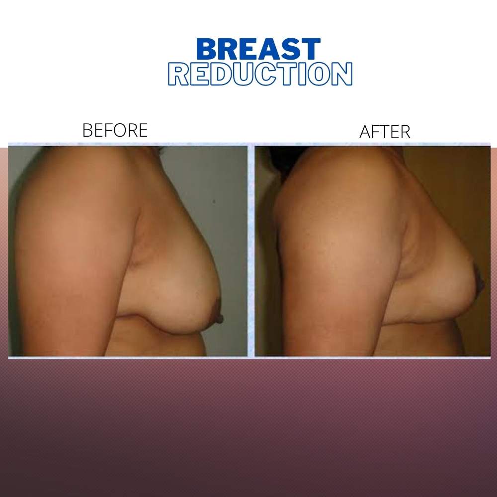 breast reduction before and after