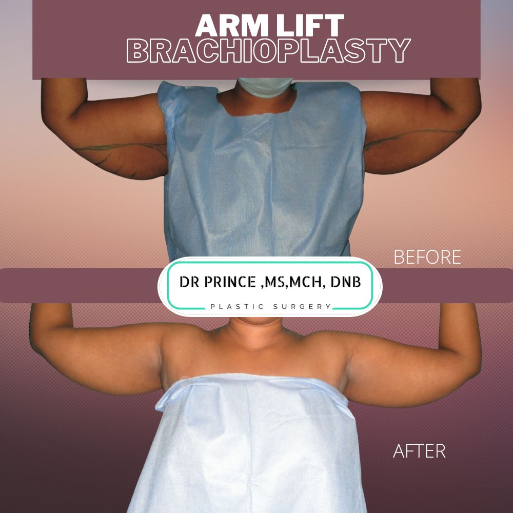 arm lift surgery in kerala