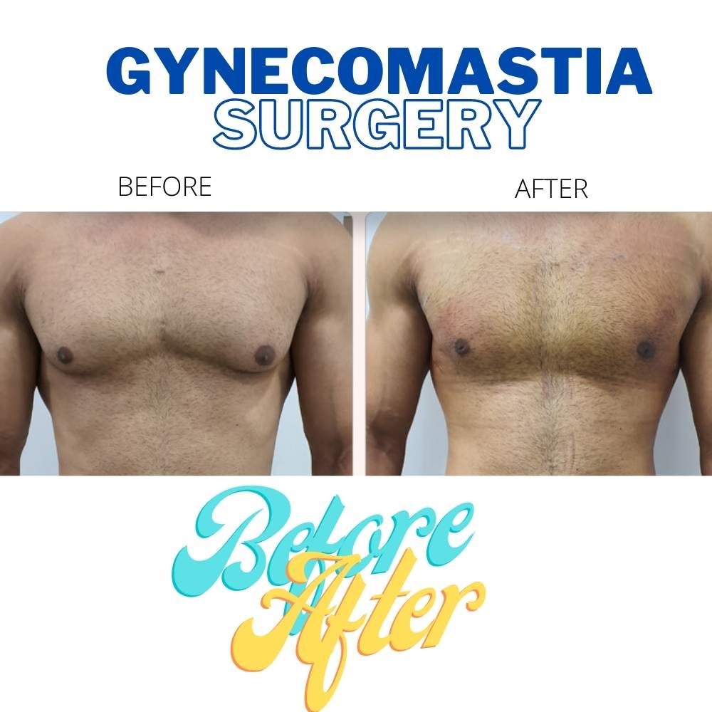 gynecomastia surgery