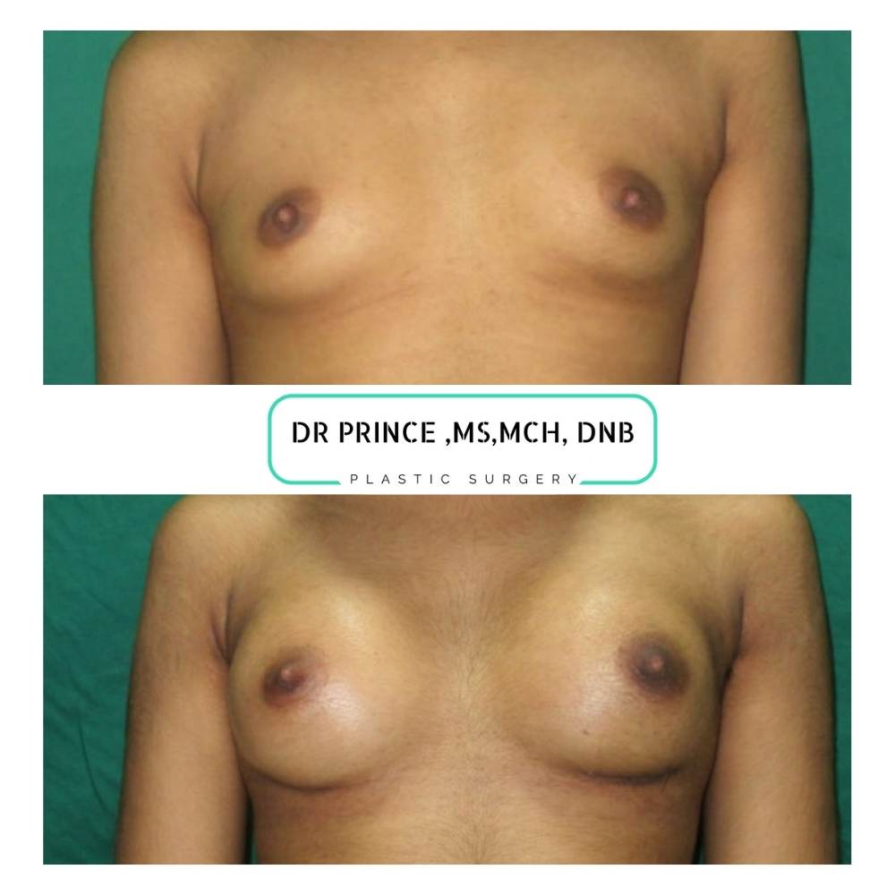 breast augmentation thrissur