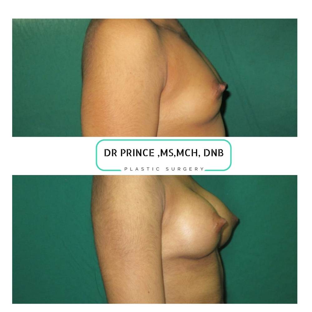 breast augmentation before and after kerala