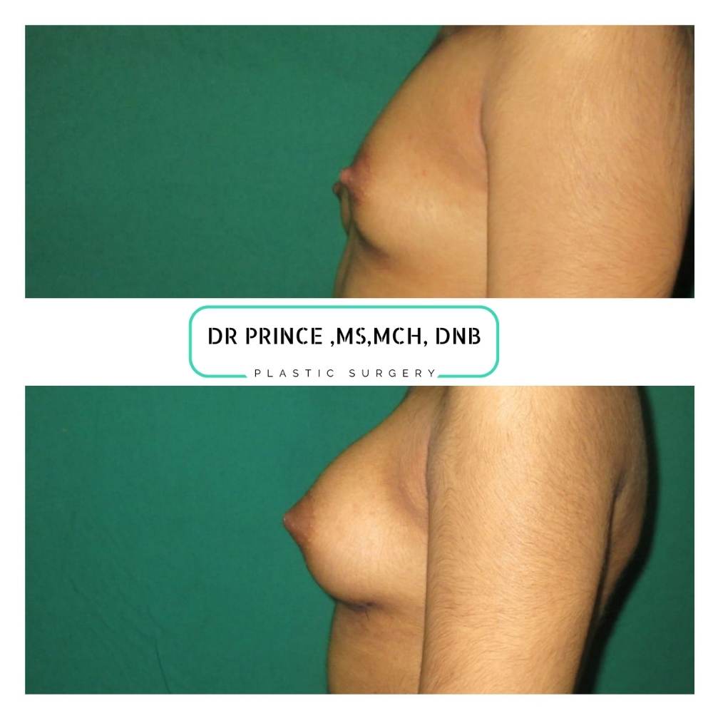 breast implant before and after kerala