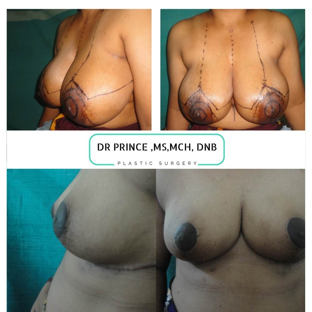 breast reduction before and after2