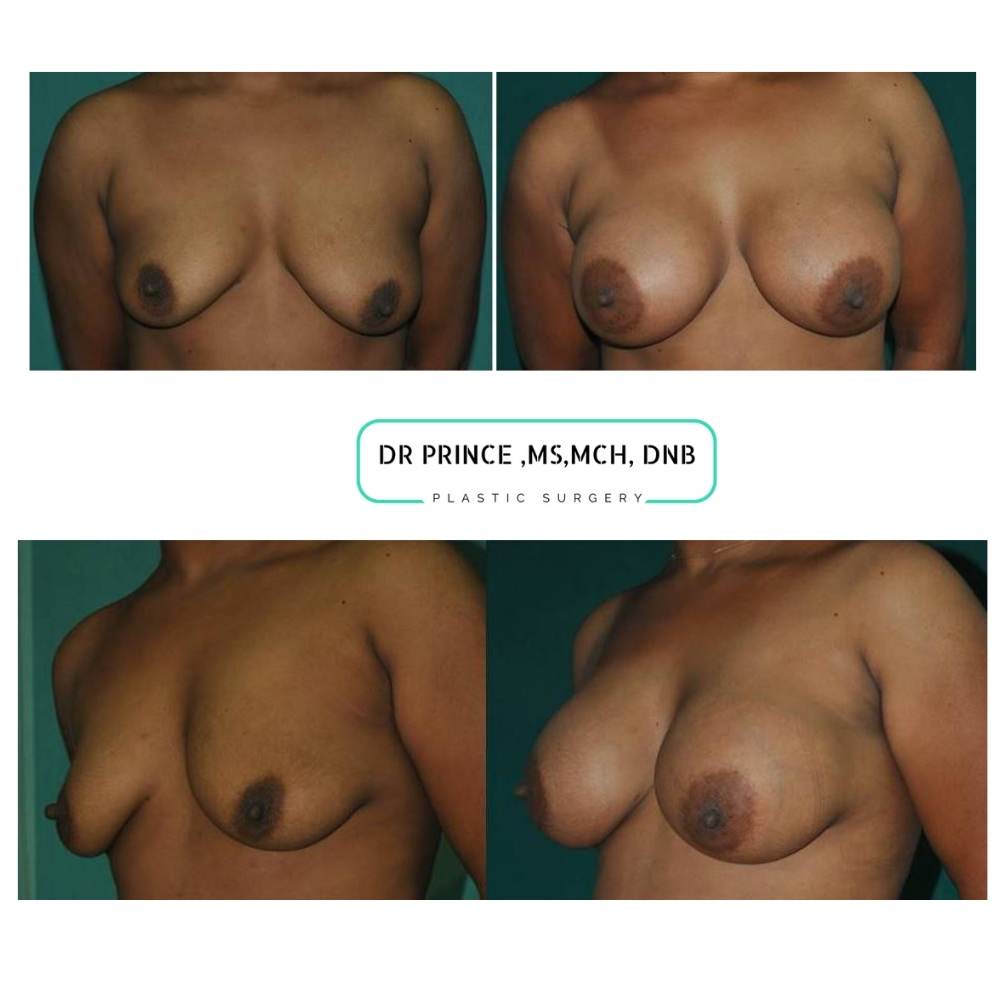 breast implant surgery kerala