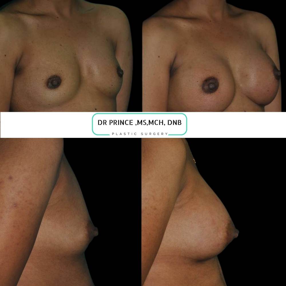 breast implant surgery thrissur