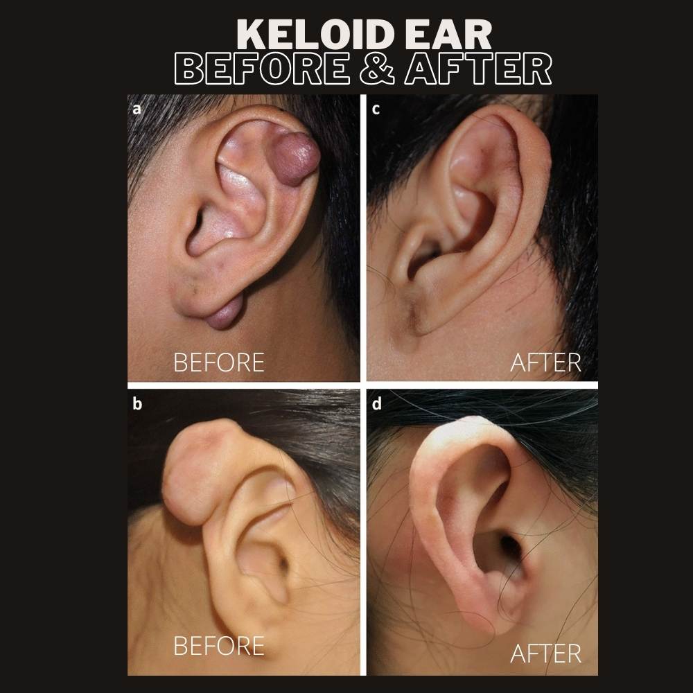 ear keloid removal kerala