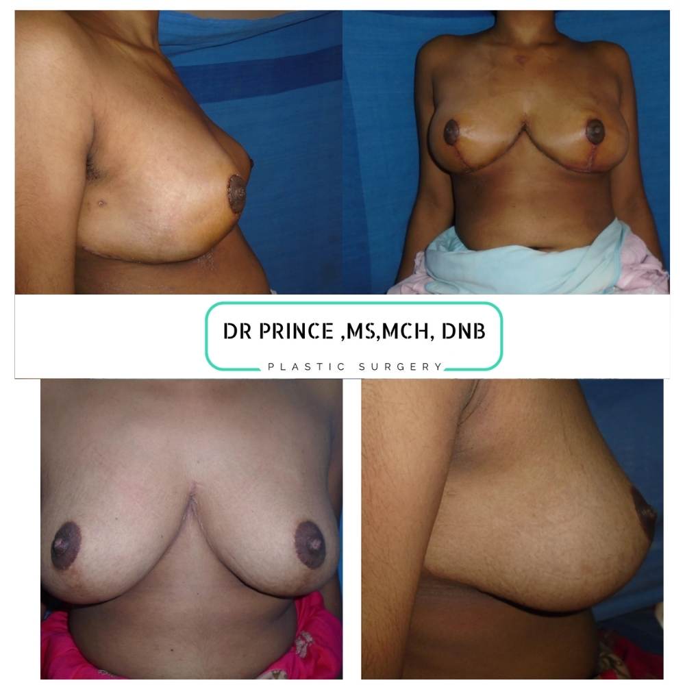 breast reducing surgery kerala