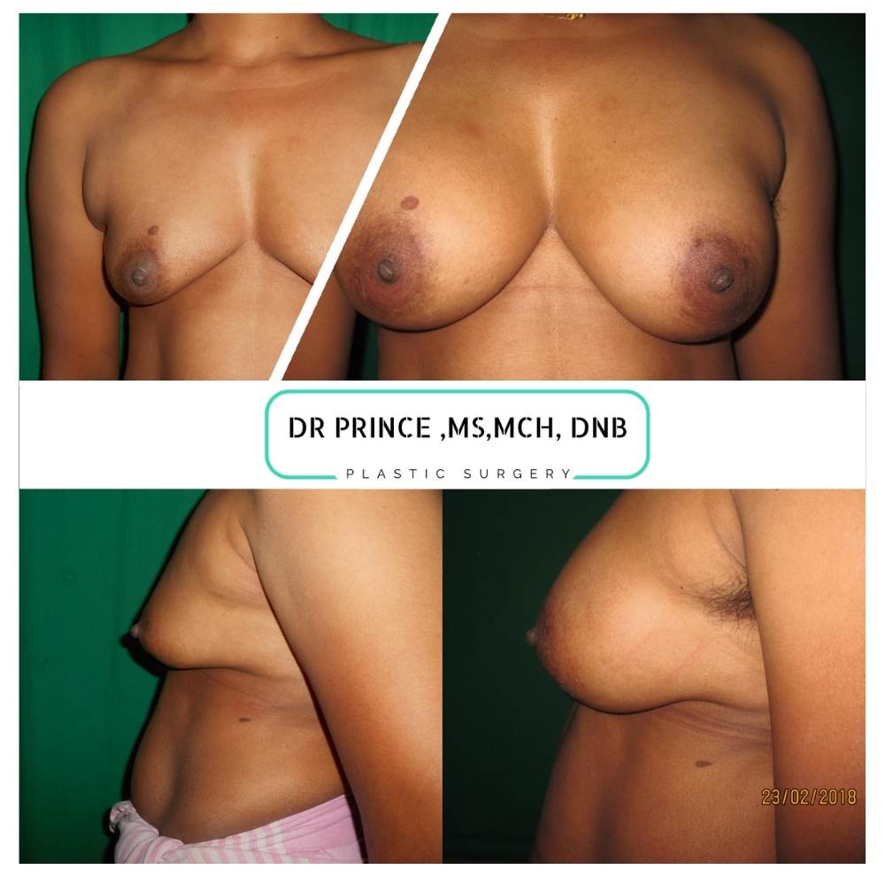 Breast augmentation kerala