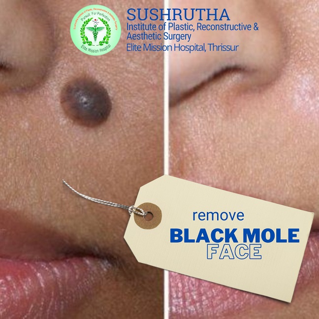 black mole removal thrissur