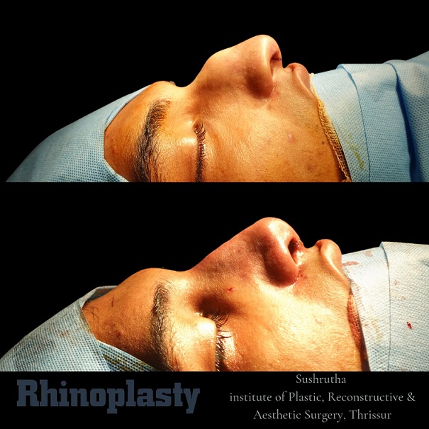 rhinoplasty before and after