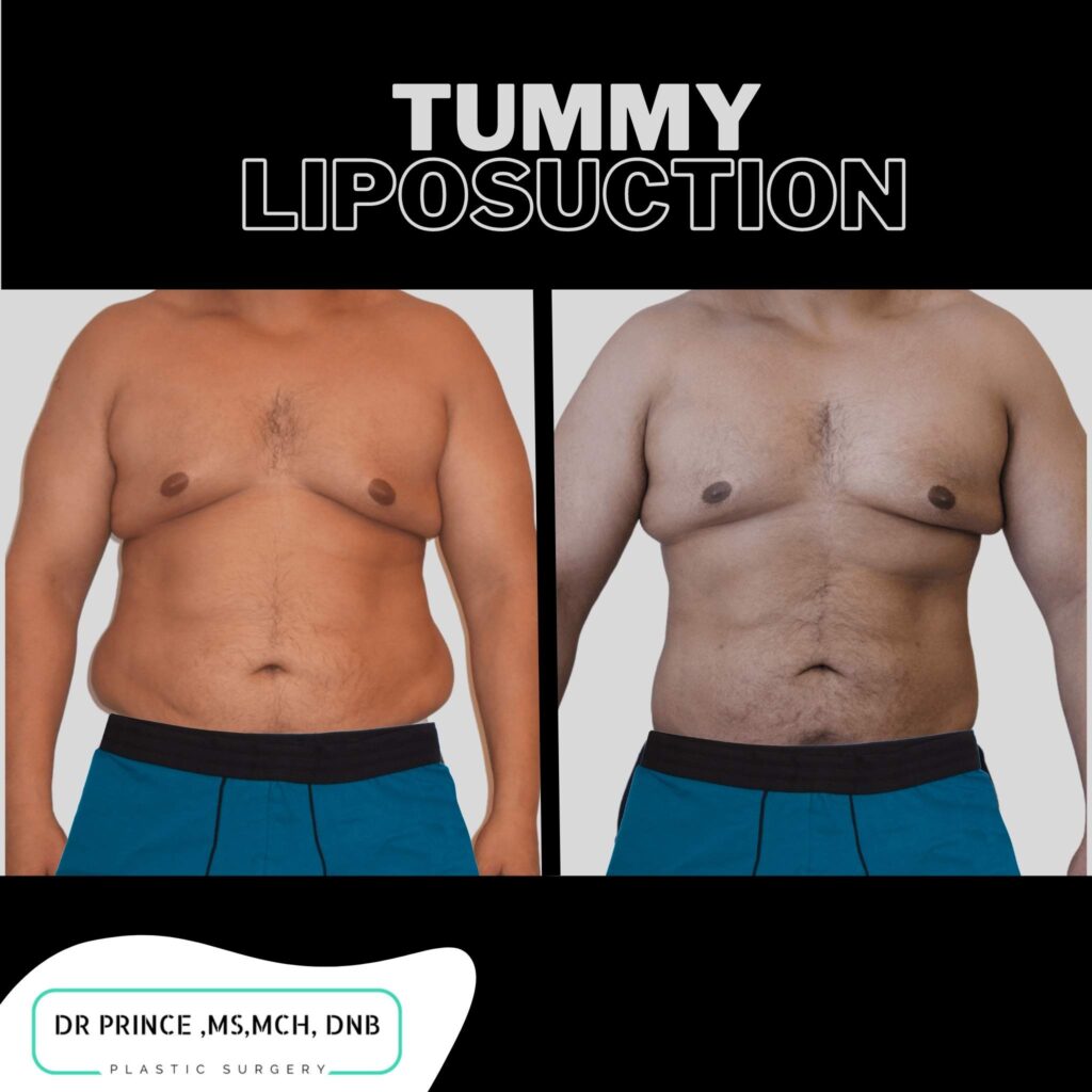 tummy liposuction kerala