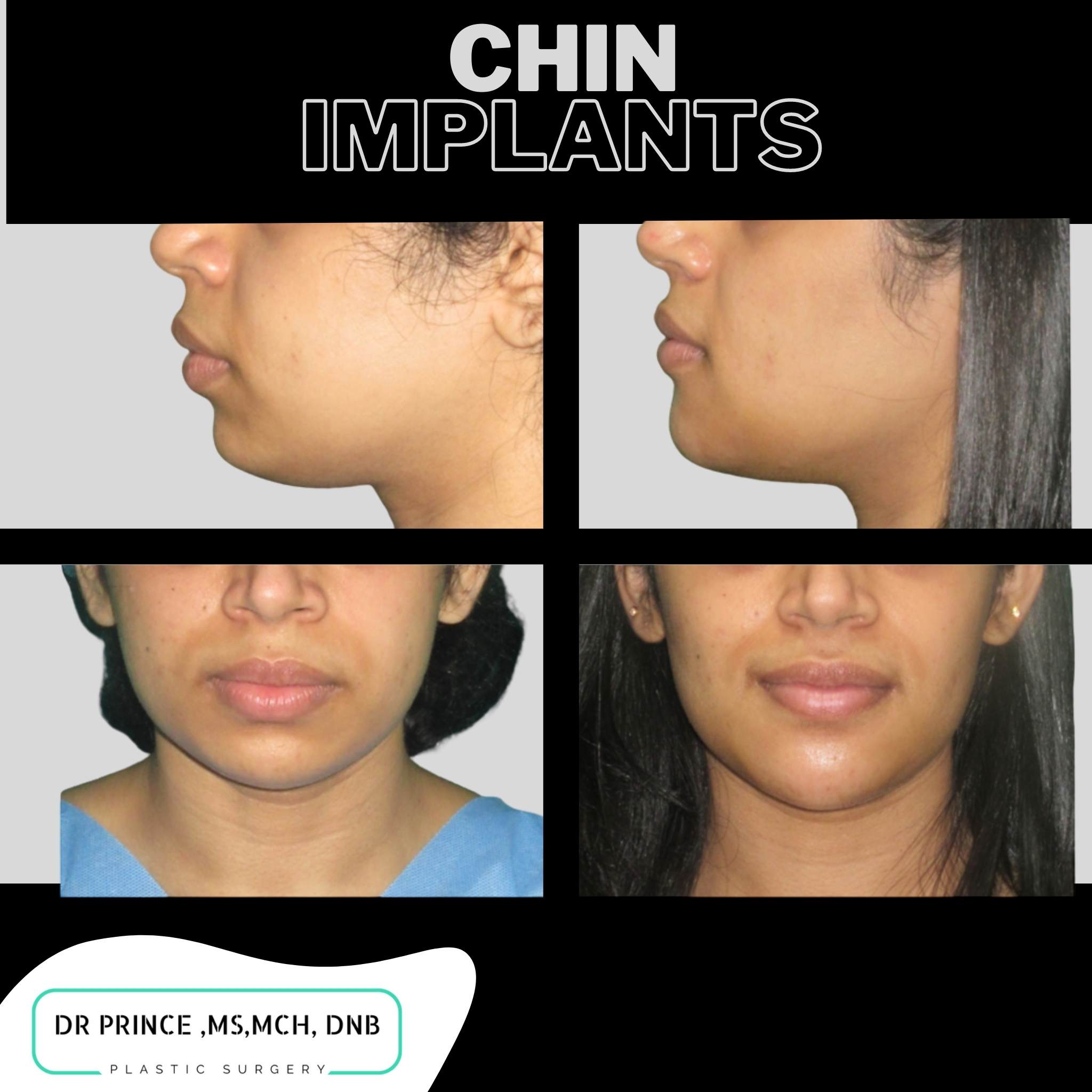 1 Chin augmentation with implants in thrissur Dr Prince