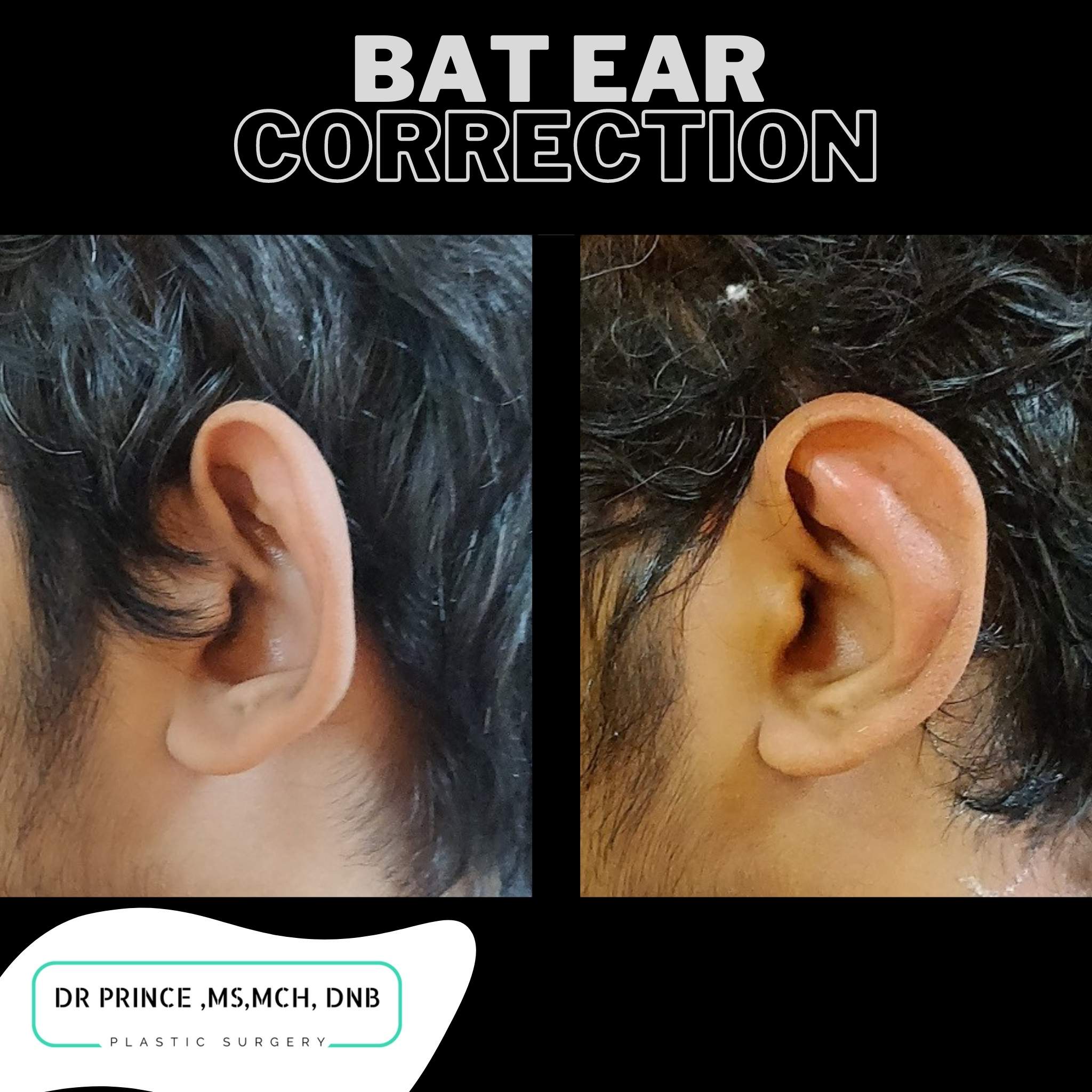 Otoplasty Thrissur, Ear Pinning kerala, Facial Procedures India