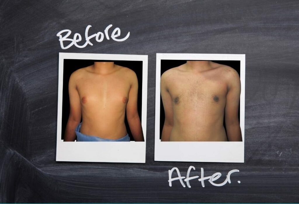 gynecomastia surgery before after kerala