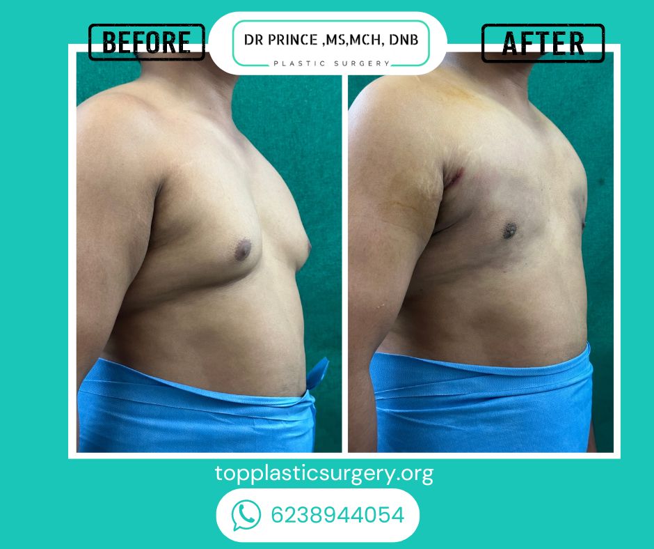 gynecomastia surery before after 12