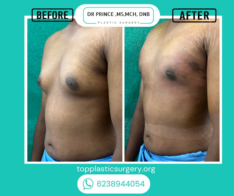 gynecomastia surery before after 13