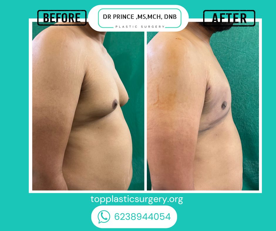 gynecomastia surery before after 17