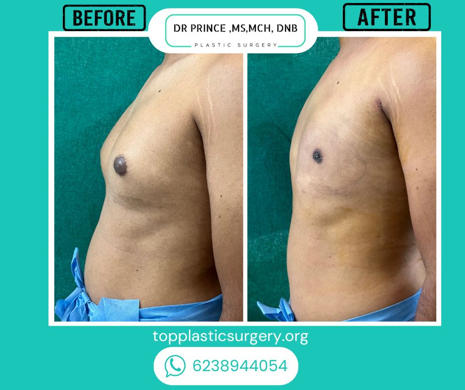 gynecomastia surery before after 19