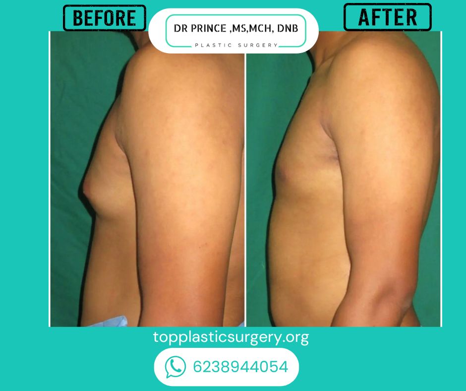 gynecomastia surery before after 21