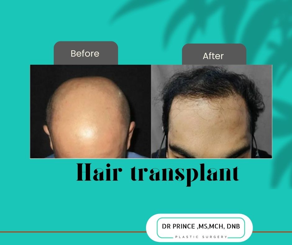 hair transplant thrissur