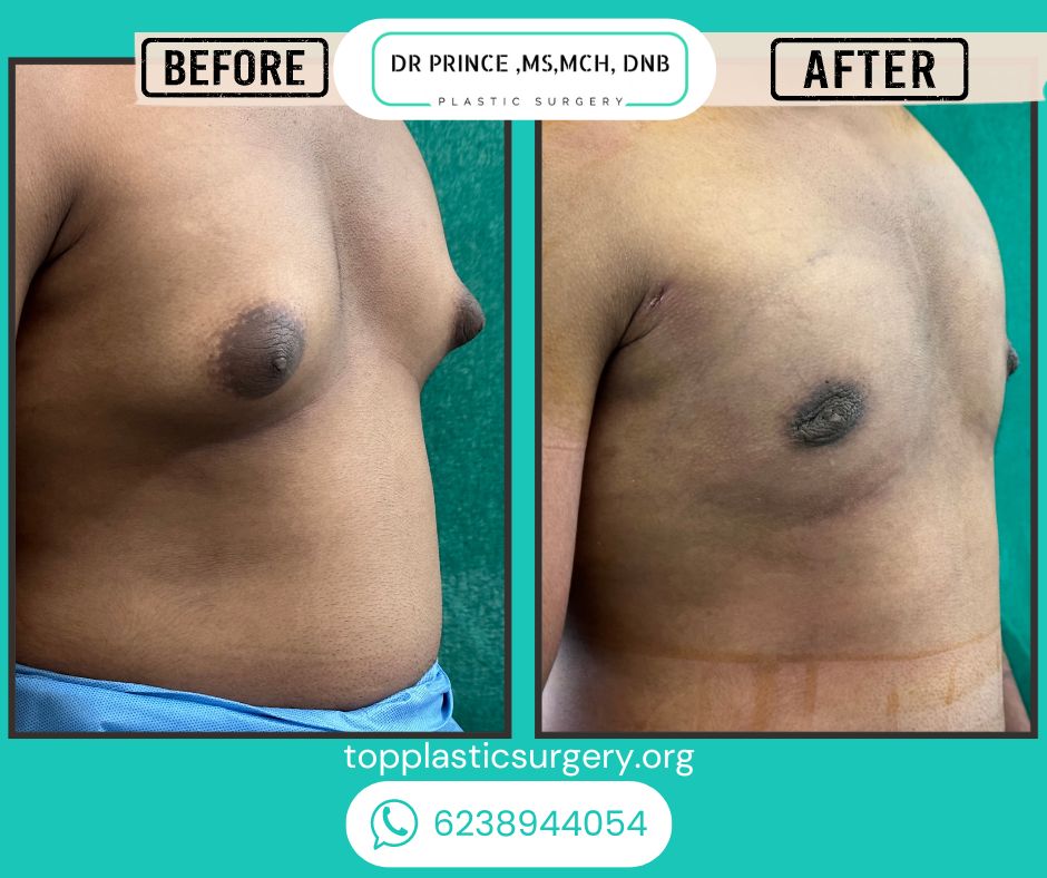 gynecomastia surgery before after 4