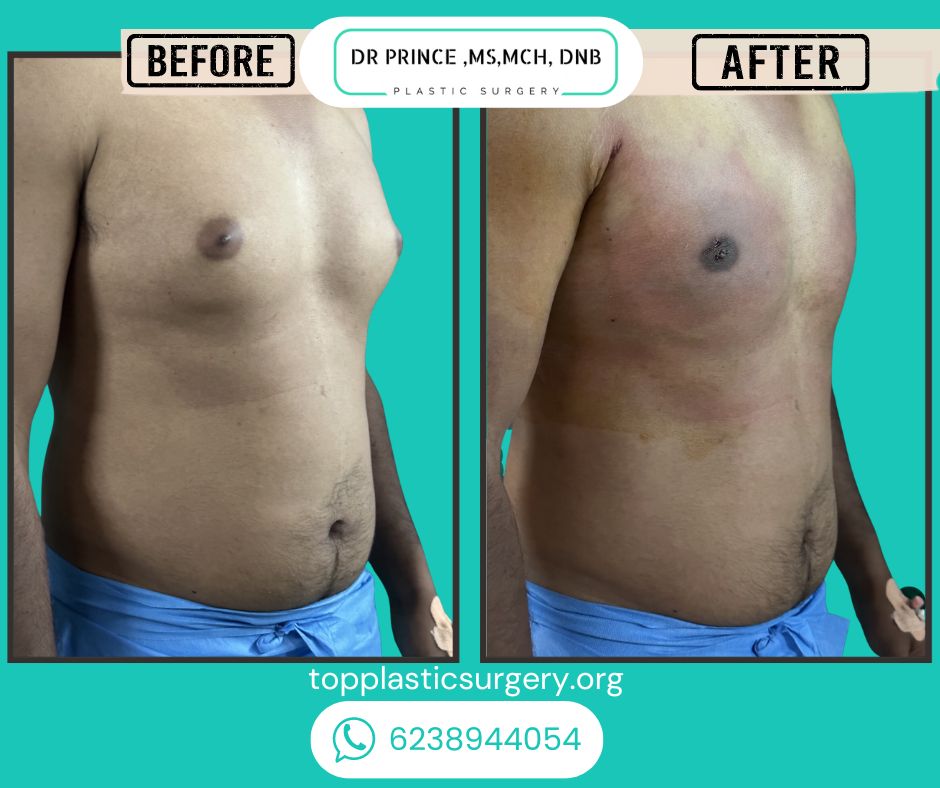 gynecomastia surgery before after 8