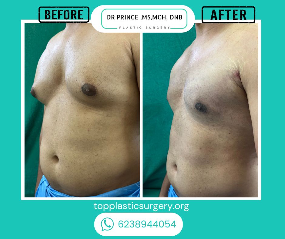gynecomastia surgery before after 9