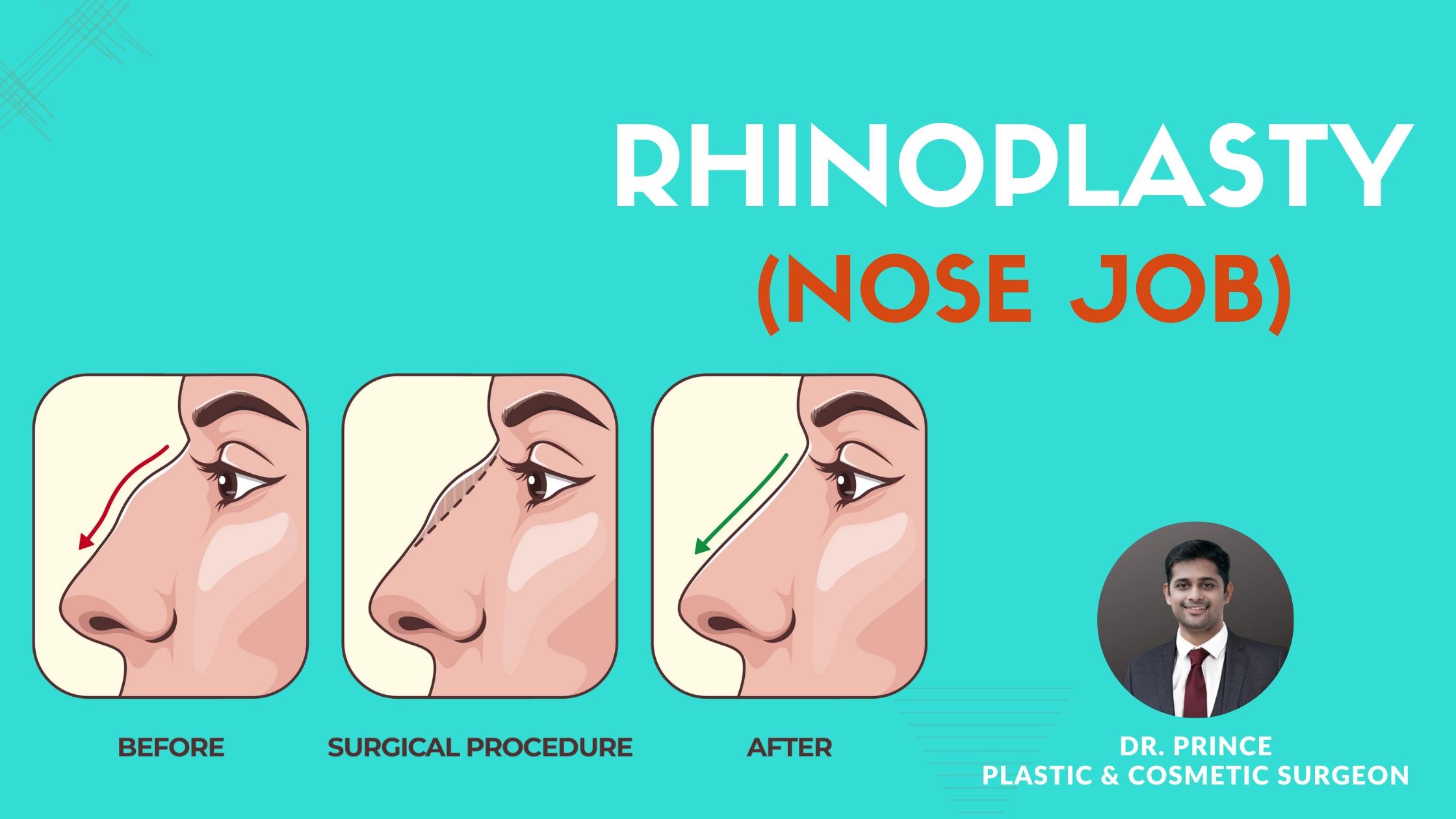 Striking before-and-after view showcasing the exceptional results of Rhinoplasty by Dr. Prince. Aesthetic refinement unfolds, revealing a transformed nasal profile with enhanced balance and natural beauty.