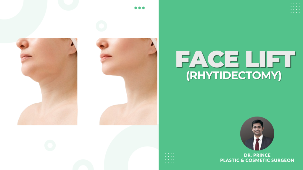 Timeless Elegance: The Art of Facial Rejuvenation through Facelift (Rhytidectomy) by Dr. Prince 