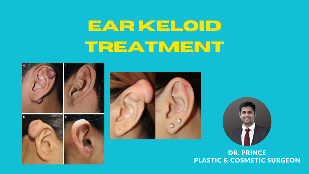 Silencing the Discomfort: A Comprehensive Guide to Ear Keloid Treatment ...