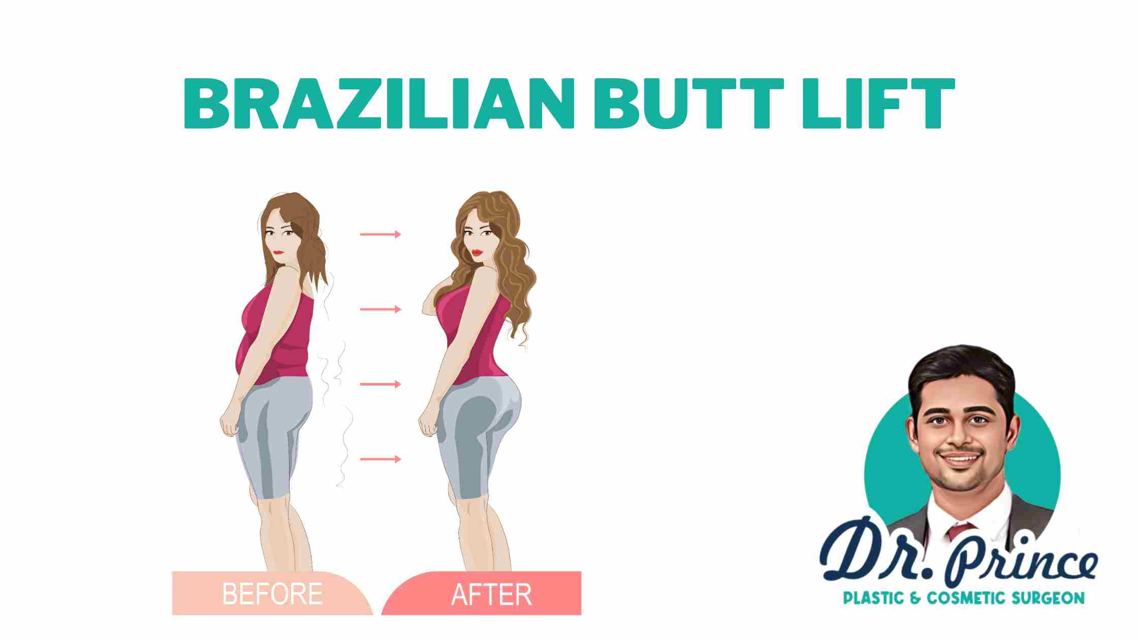 Dr. Prince performing a Brazilian Butt Lift surgery, enhancing buttock shape and volume through fat transfer.