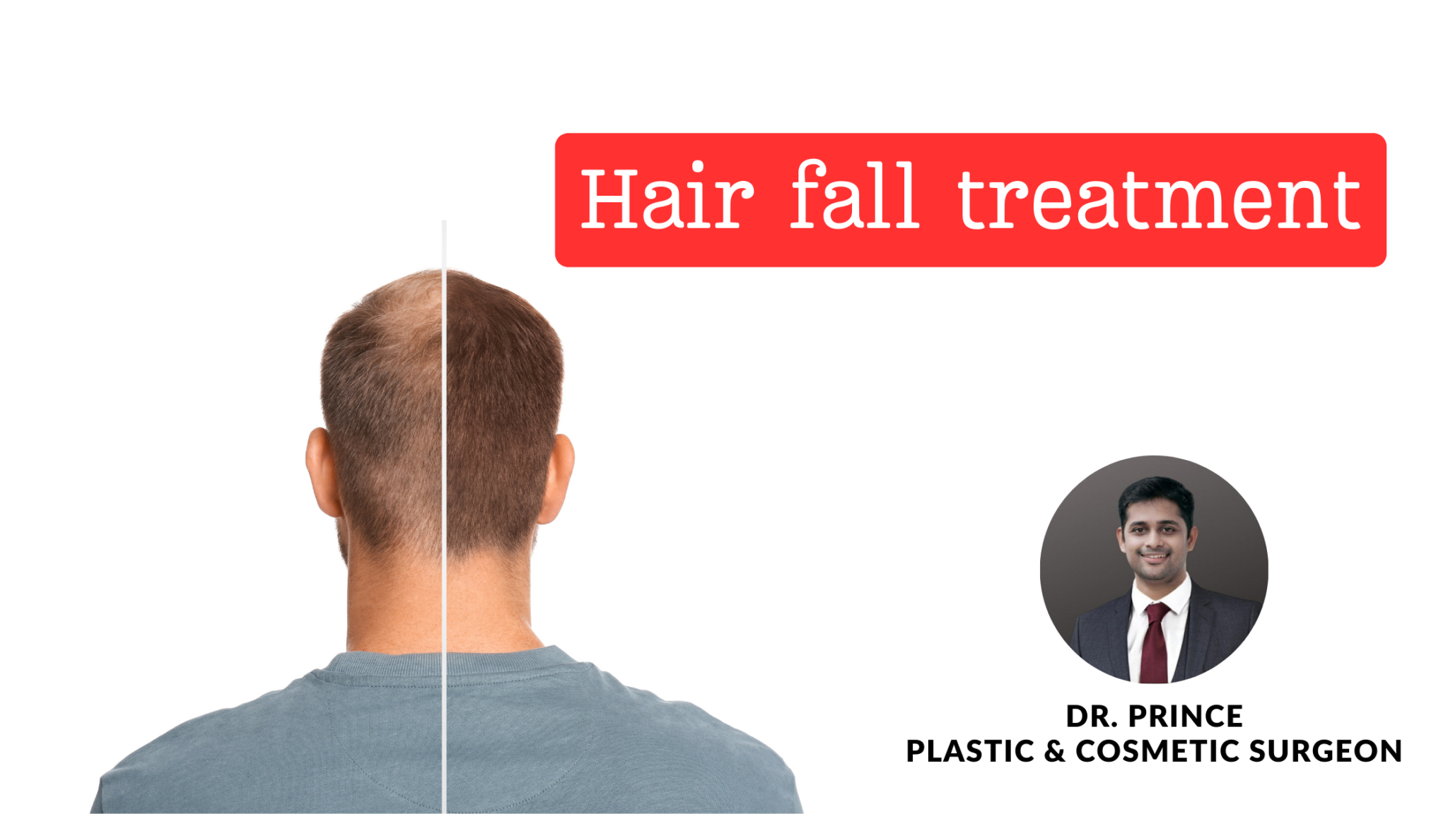 Hair Fall Treatment Title Taming Tresses A Comprehensive Guide To Hair Fall Treatment By Dr 5311