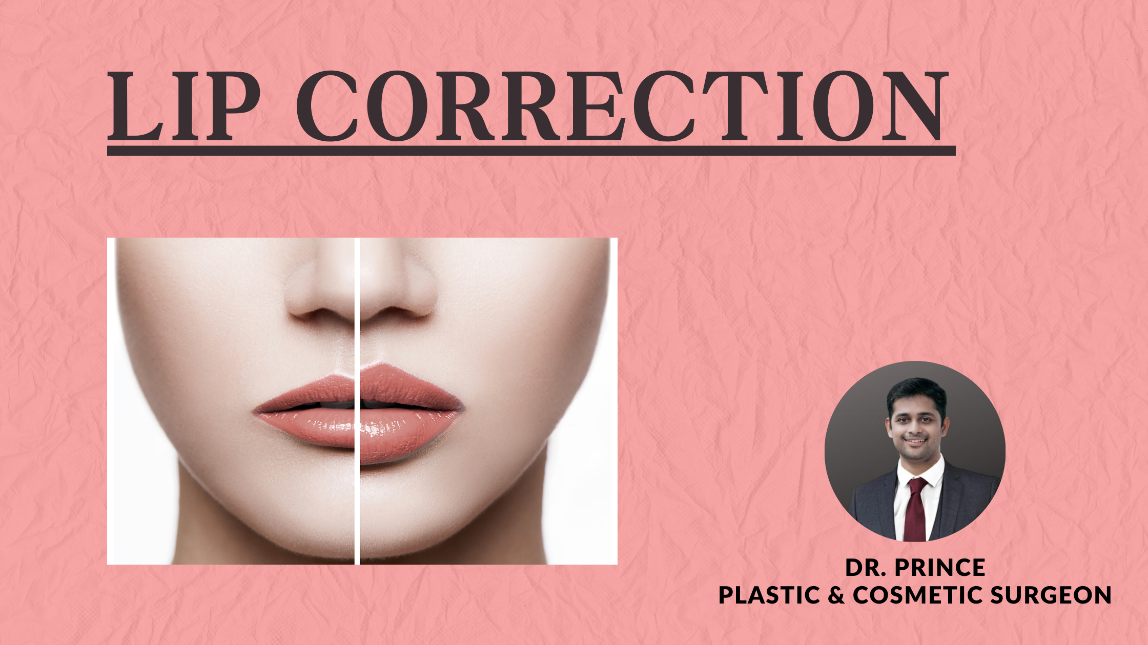 Dr. Prince performs lip correction, skillfully restoring natural symmetry and enhancing facial features for a harmonious appearance.
