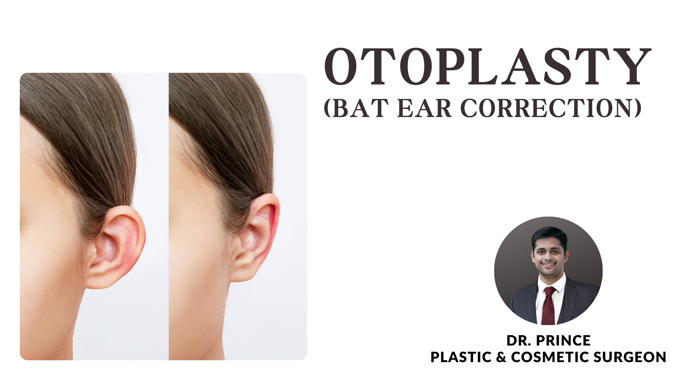 Dr. Prince performs otoplasty, sculpting natural and harmonious ear contours for enhanced aesthetics.