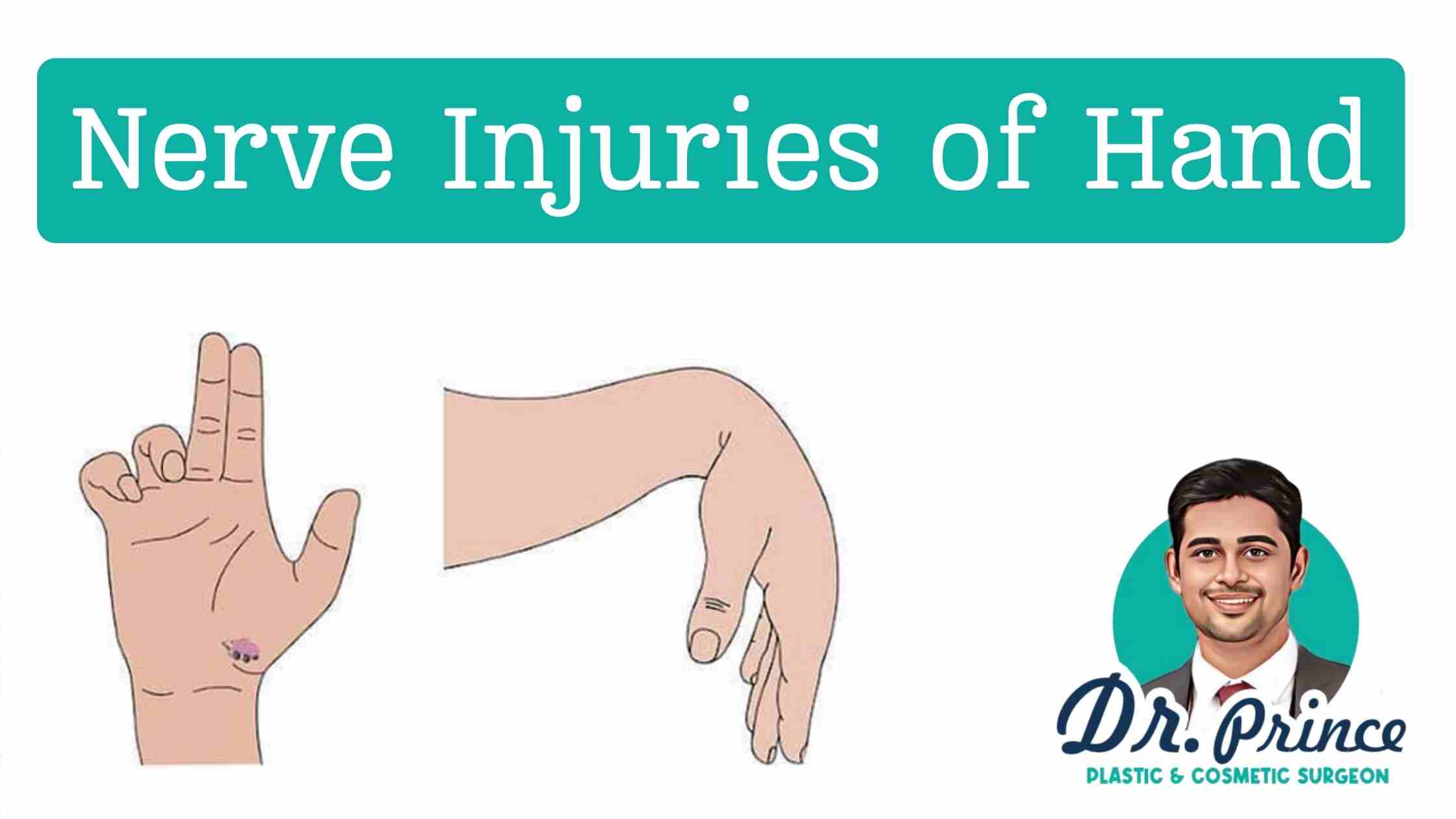 Nerve Injuries of the Hand Specialist - Dr. Prince at Susrutha Hospital, Kerala