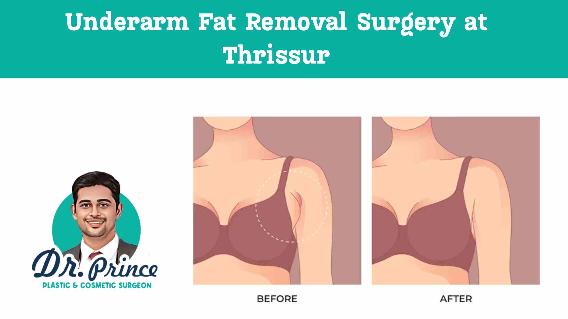 Underarm Fat Removal Surgery - Dr. Prince at Sushrutha Institute of Plastic Surgery, Thrissur.