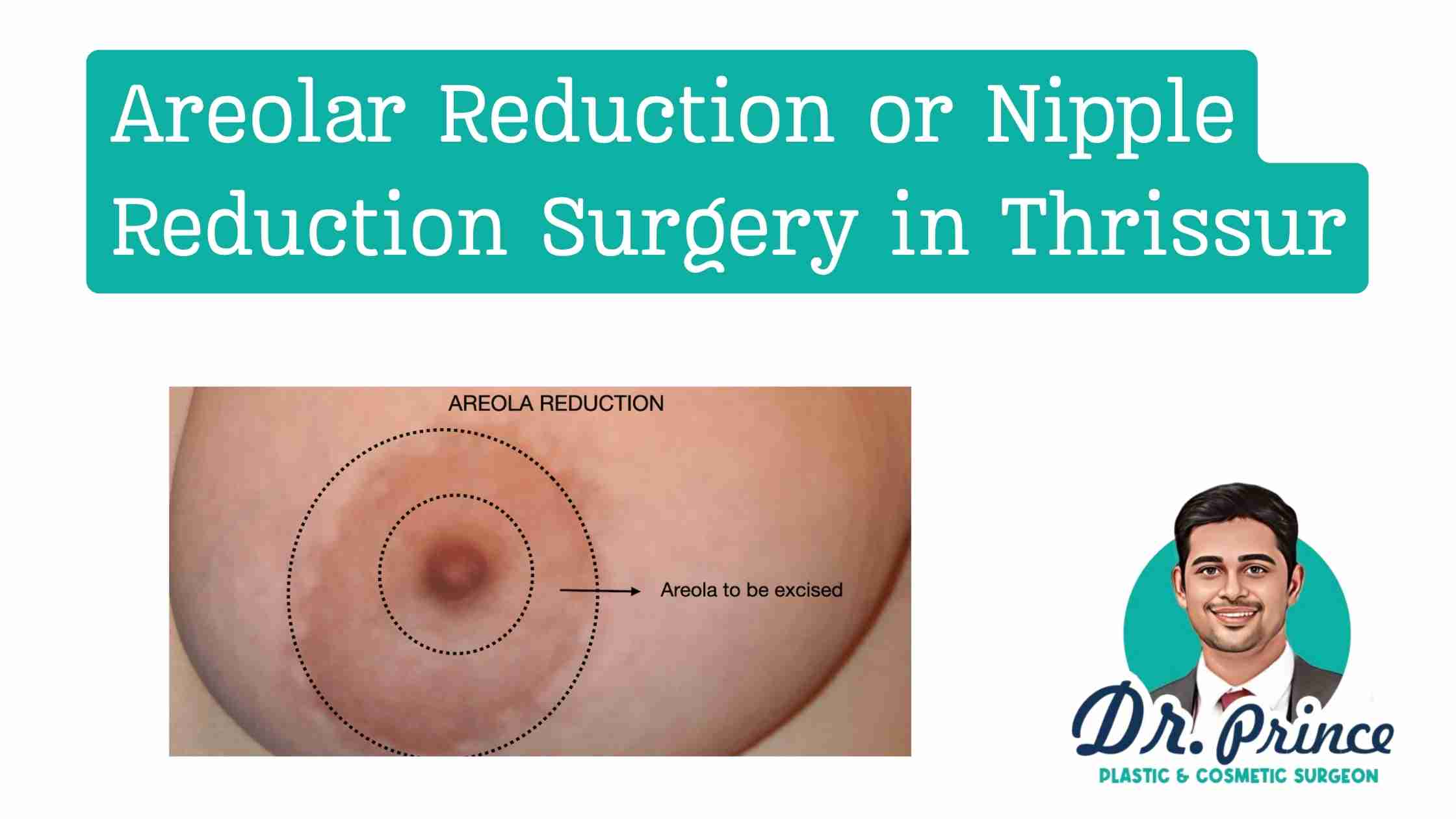 Areolar and Nipple Reduction Surgery - Dr. Prince at Sushrutha Institute of Plastic Surgery, Thrissur.