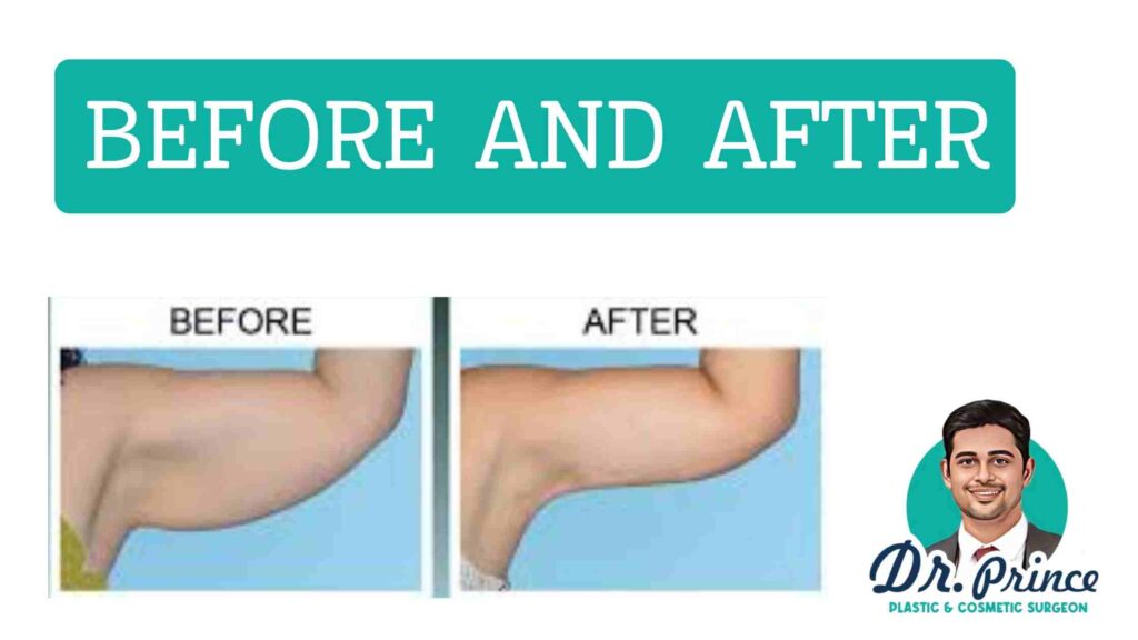 Before and after images showcasing the transformative results of Dr. Prince's arm lift surgery (brachioplasty) procedures.