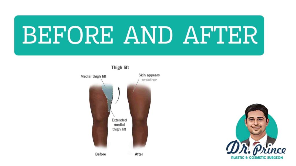 Thigh Lift Before and After: A visual representation showcasing the transformative results of thigh lift surgery, highlighting the improvement in contour and reduction of excess skin on the upper legs.