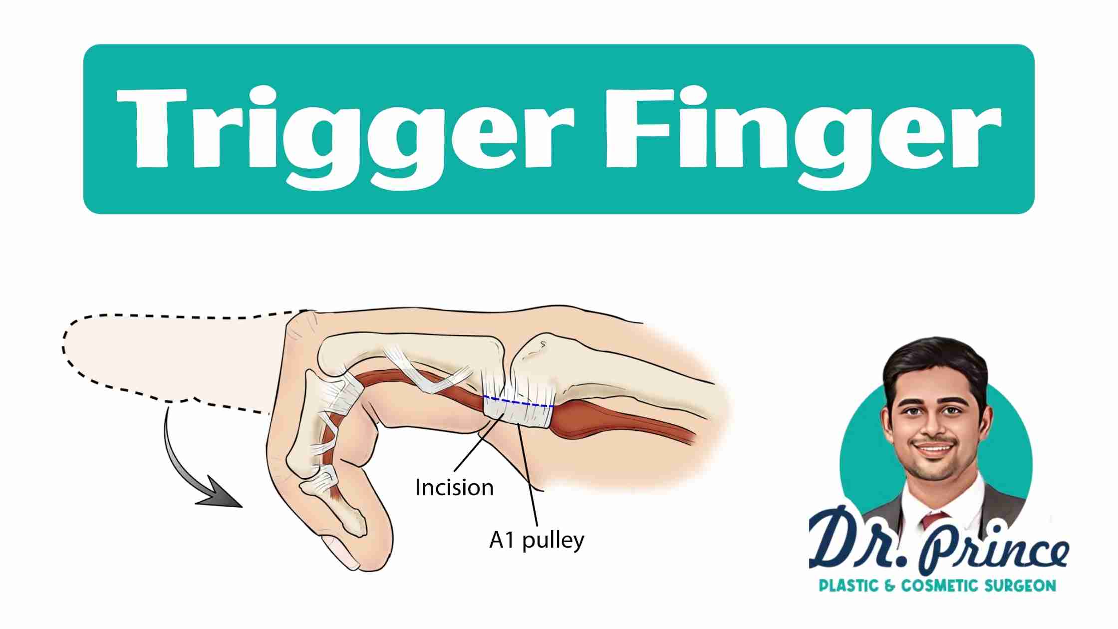Illustration of a Hand Demonstrating Trigger Finger Symptoms - Dr. Prince's Expertise at Your Service