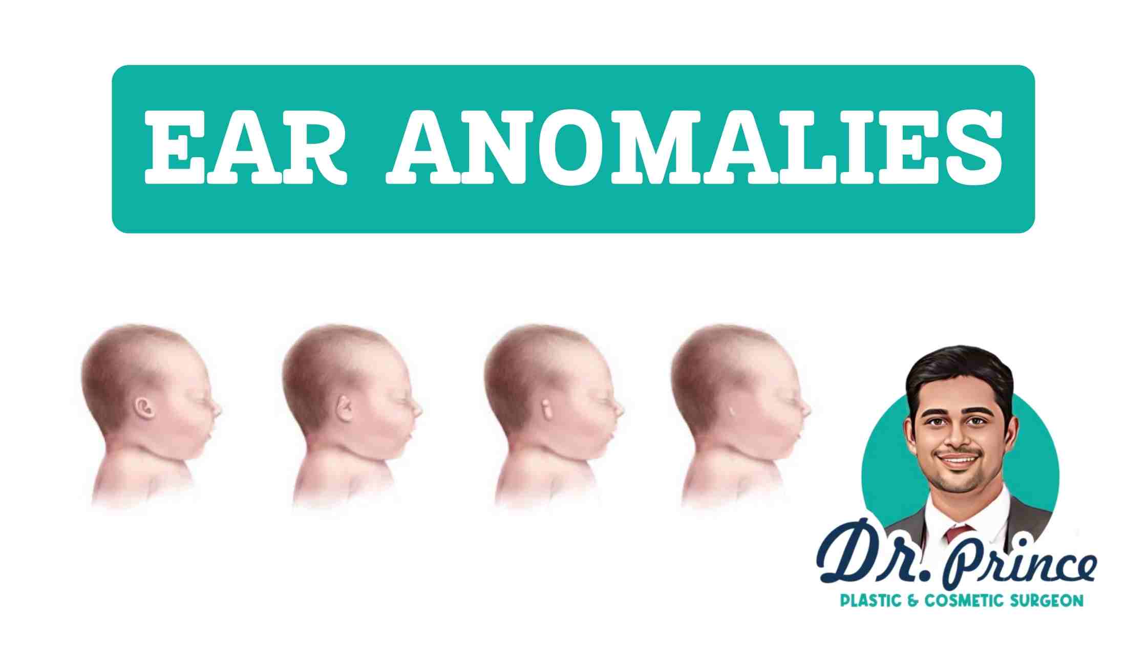Congenital Ear Deformities: Illustration showing various ear anomalies and deformities.