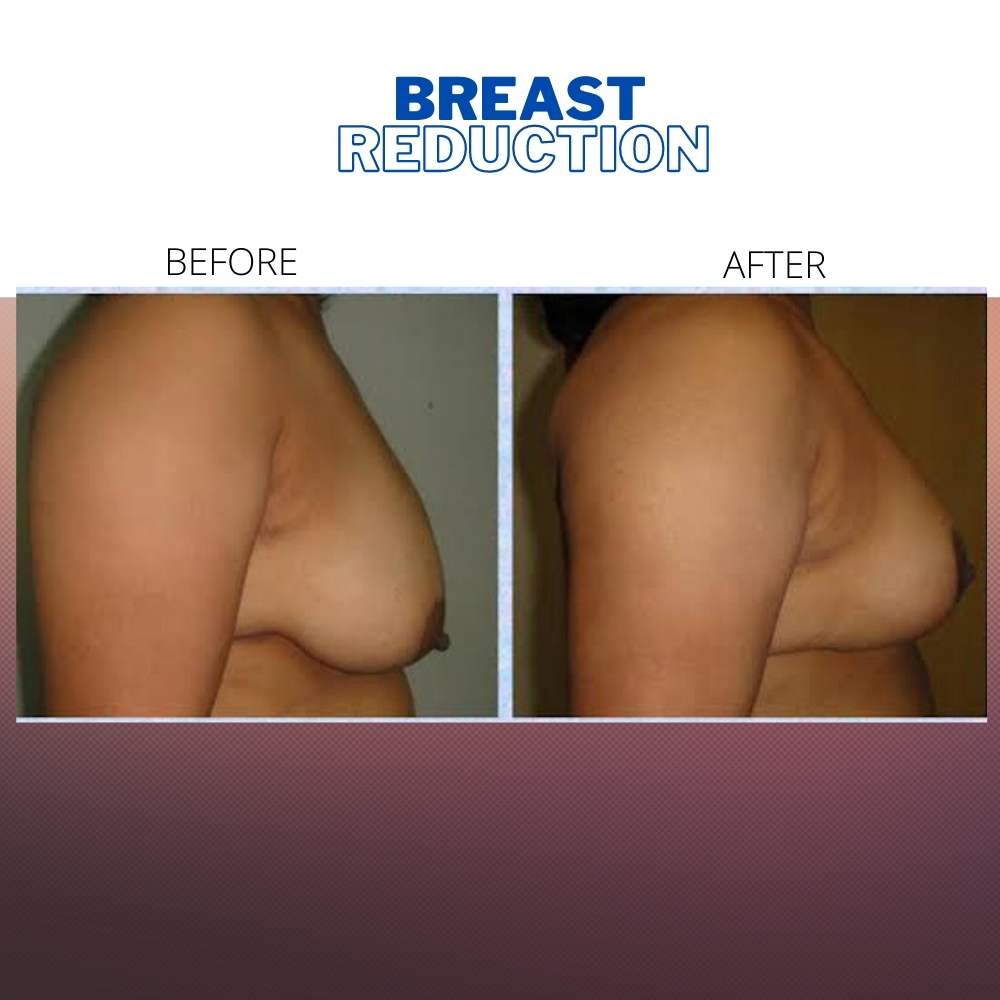 Before-and-after image illustrating the transformative results of a breast reduction surgery.