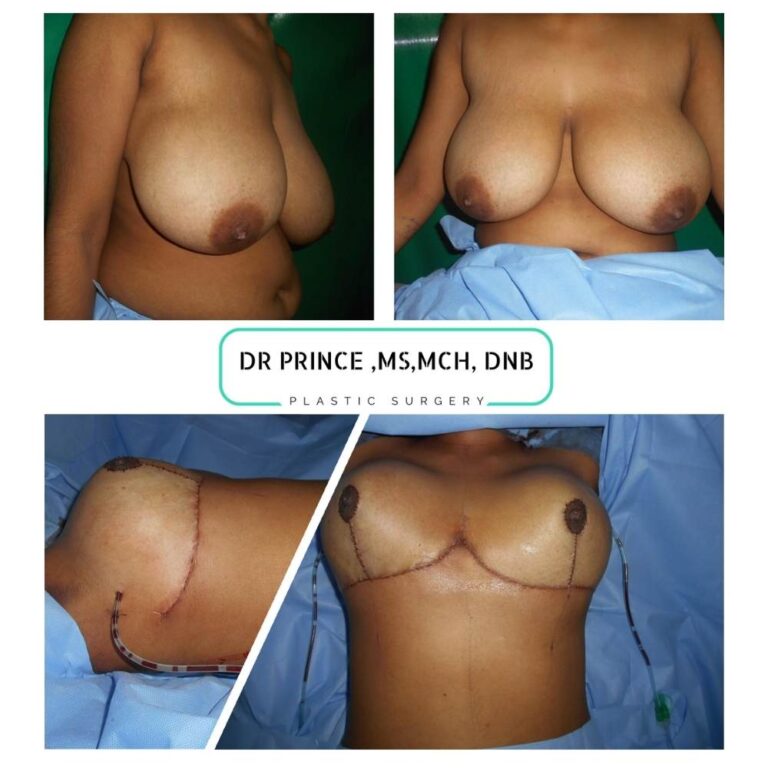 Comparison image showcasing the results of breast reduction surgery, enhancing comfort and aesthetics.