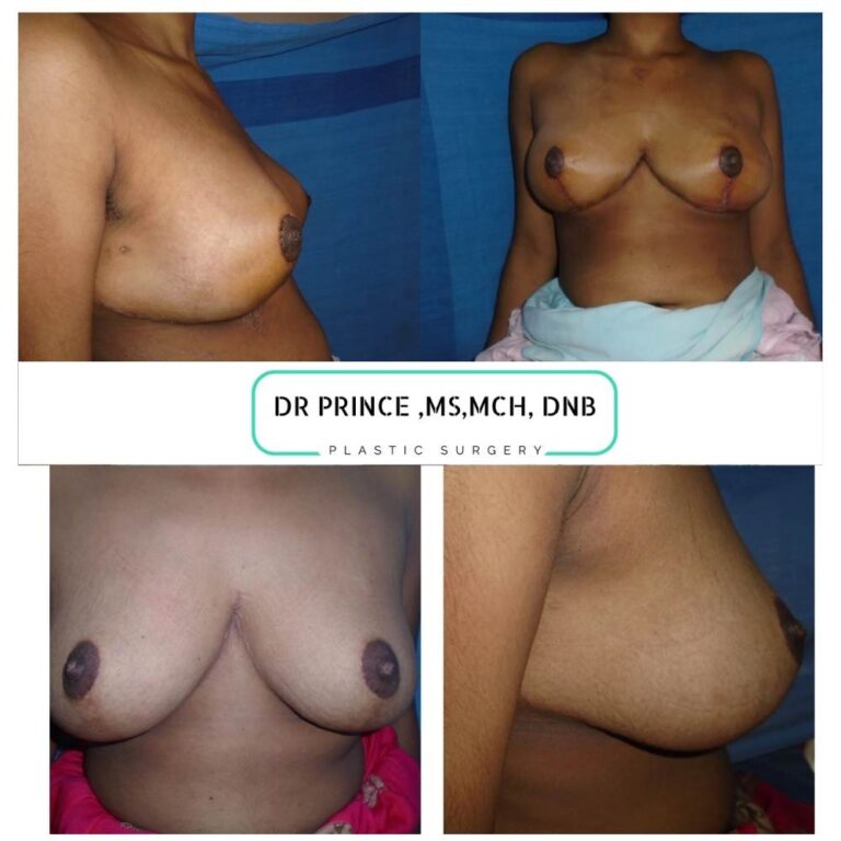 Dramatic transformation: Before and after images showcasing the positive impact of breast reduction surgery.