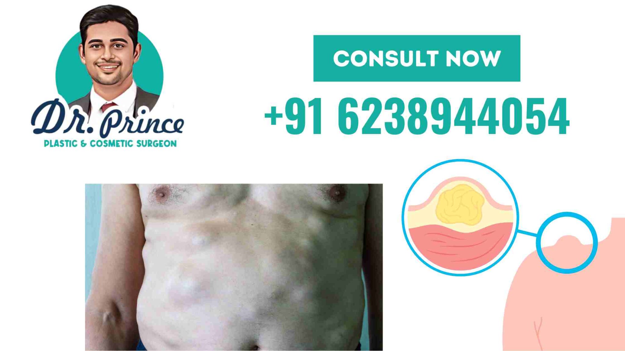 Comprehensive Guide on Multiple Lipomas and Lipoma Removal Surgery in ...