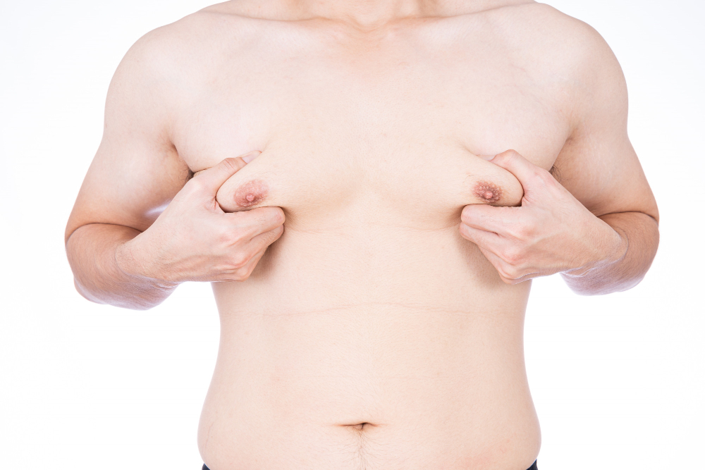 Before and after images of gynecomastia surgery performed by Dr. Prince in Kozhikode