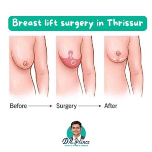 Before and after image showcasing the transformative effects of breast lift surgery for enhanced contours and renewed confidence.