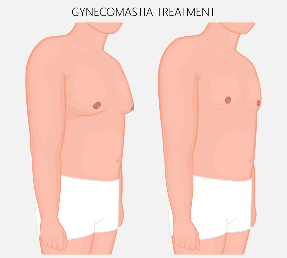 Comparison of pre and post-operative gynecomastia surgery results in Malappuram