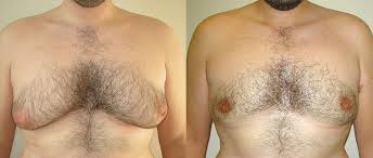 Before and after images showcasing the results of gynecomastia surgery in Palakkad by Dr. Prince